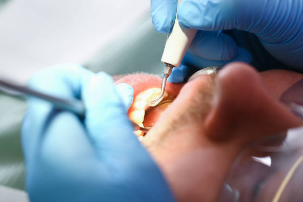 Best Emergency Tooth Extraction in Brevard, NC